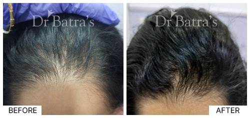 Hair Falling Treatment